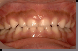 上下の歯並びを正面から撮影した口腔内の写真