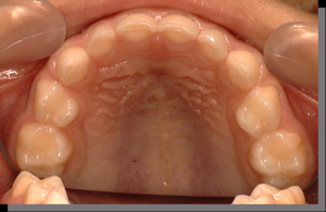歯列と口蓋全体を上から撮影した口腔内の写真