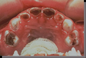 乳歯が広範に黒くなっている口腔内を上から撮影した写真